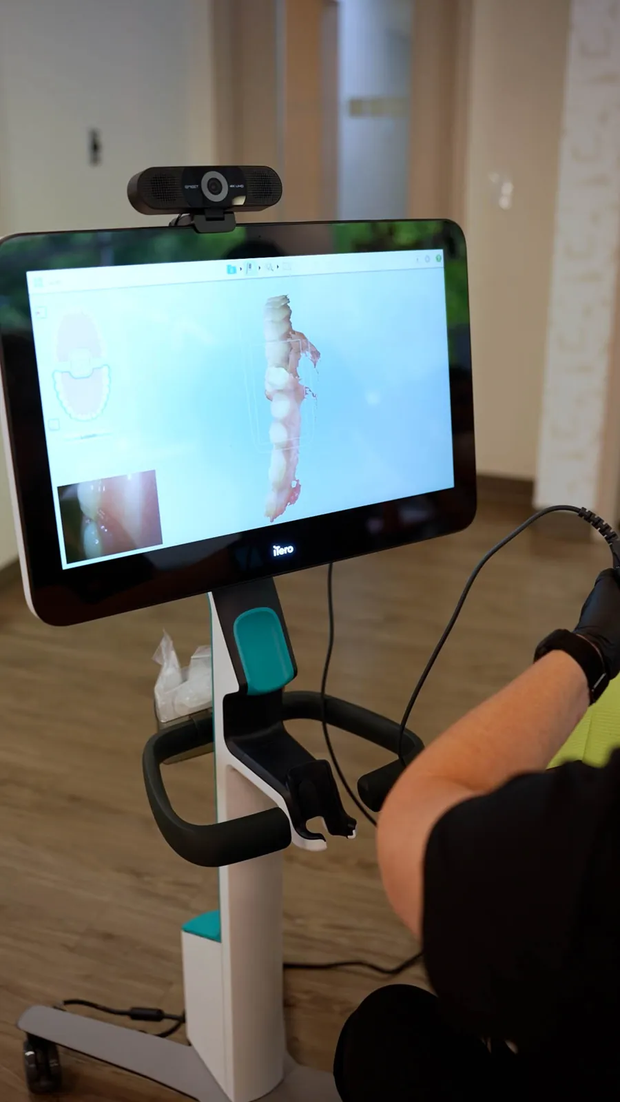 The iTero scan screen showing a digital tooth model